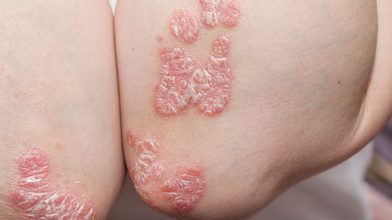 Psoriasis on the elbows