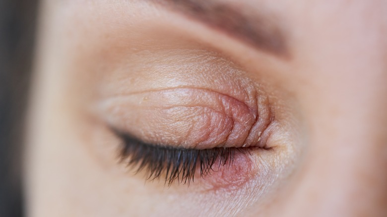 person with red, swollen eyelid