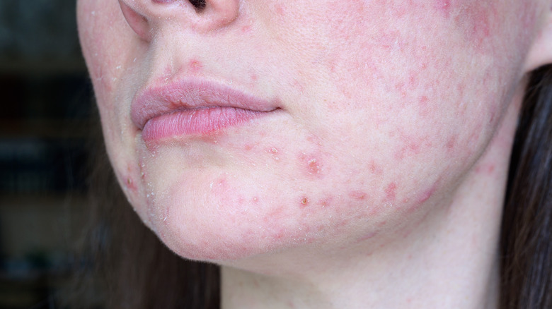 acne flareup on skin
