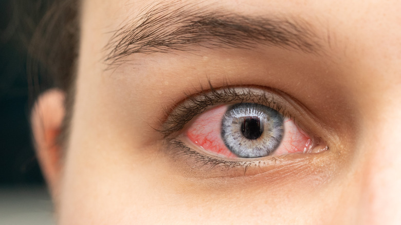 Red, inflamed eye