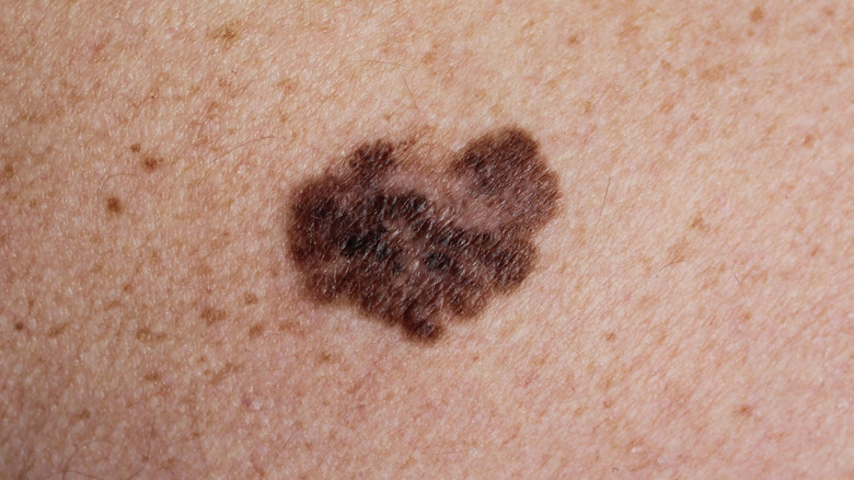 melanoma on skin
