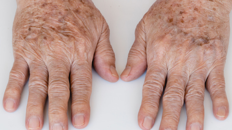 hands with age spots