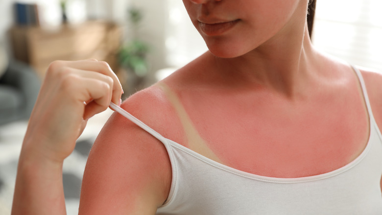 woman with sunburn