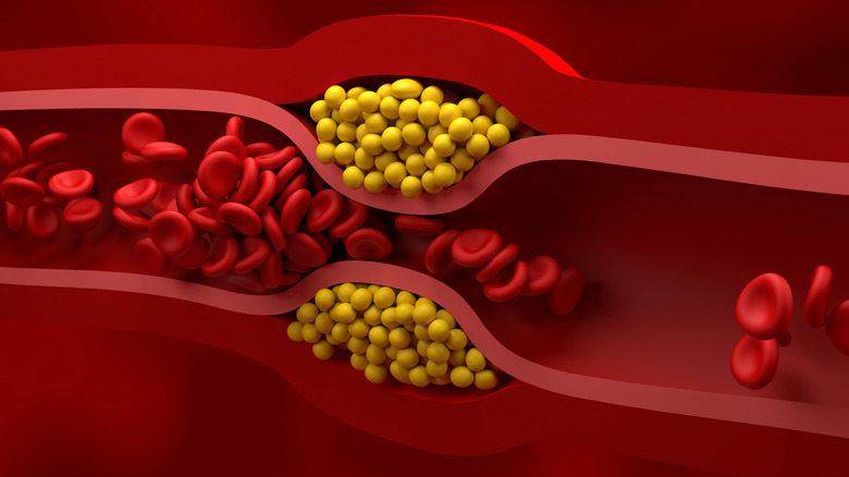 cholesterol buildup in artery