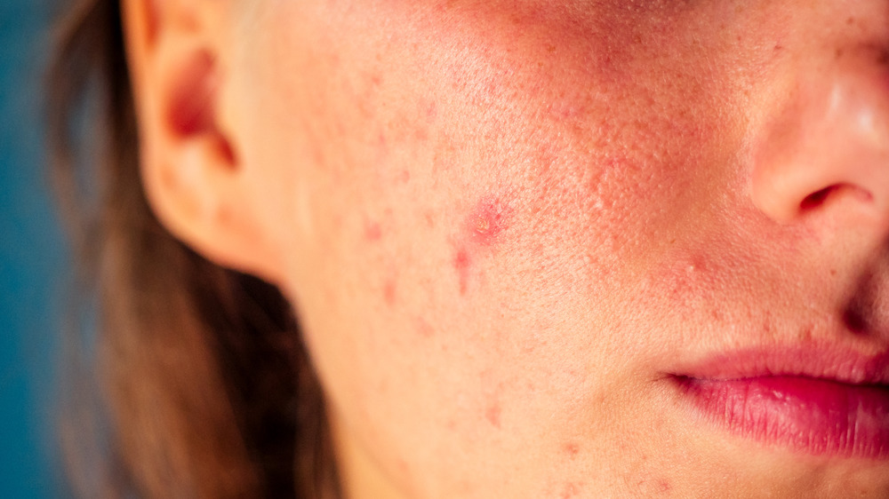 woman with acne