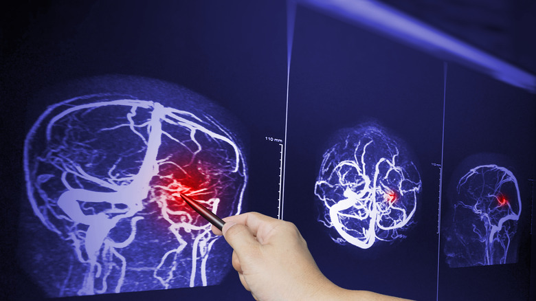 MRI of bleeding inside brain