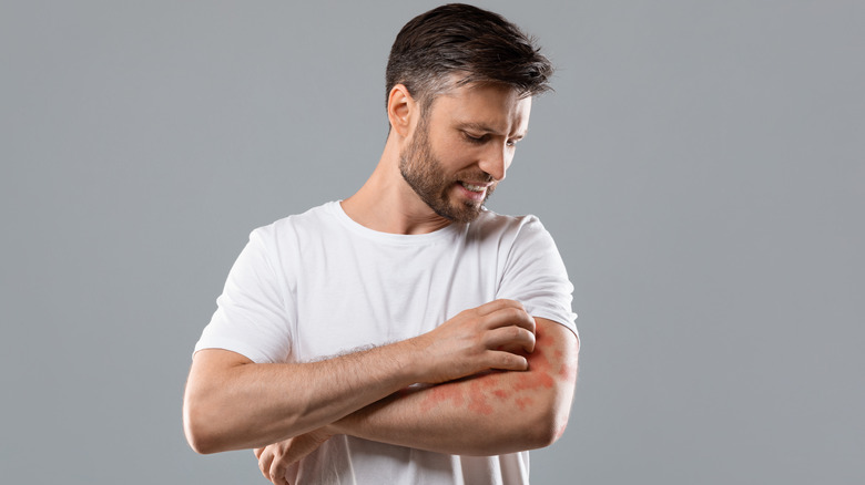 Man scratching arm rash