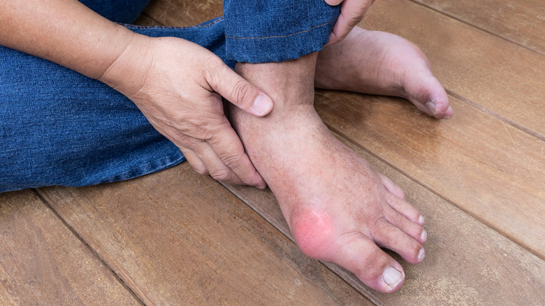 A foot with gout 