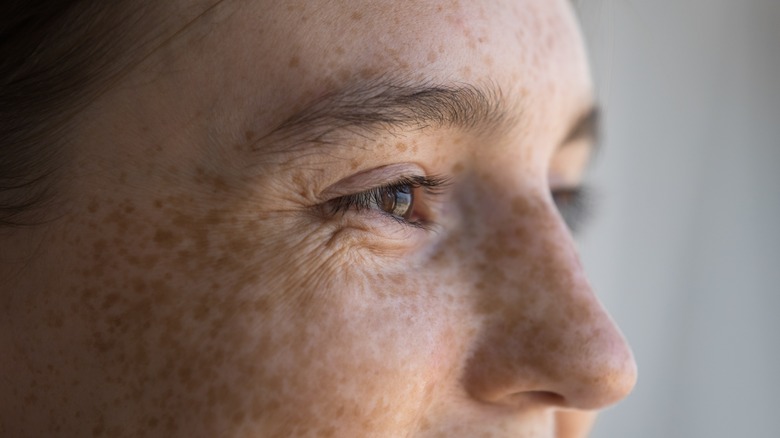 Person with freckles