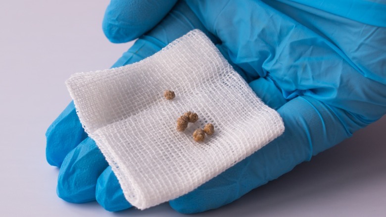 surgeon holds gallstones on piece of gauze