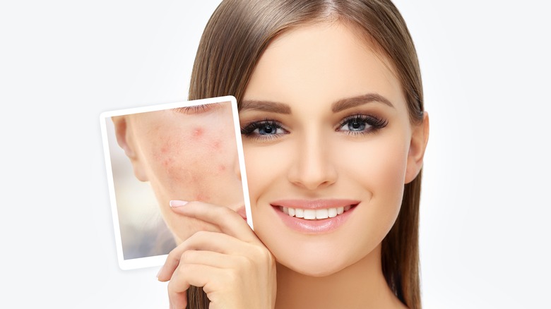 before and after picture of acne scars