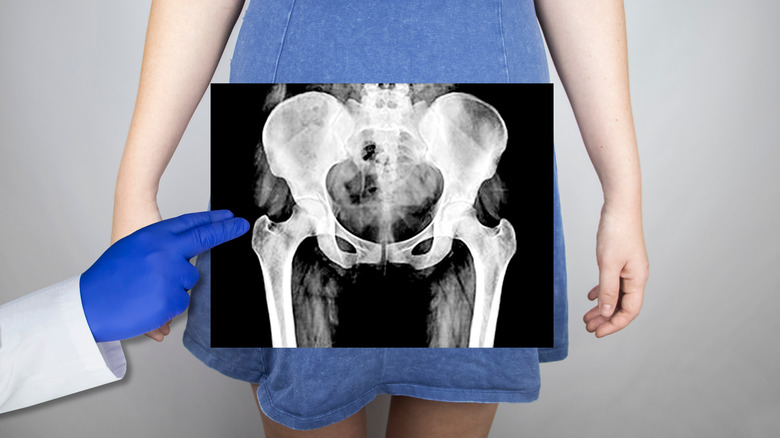 doctor holds x-ray of pelvis in front of woman