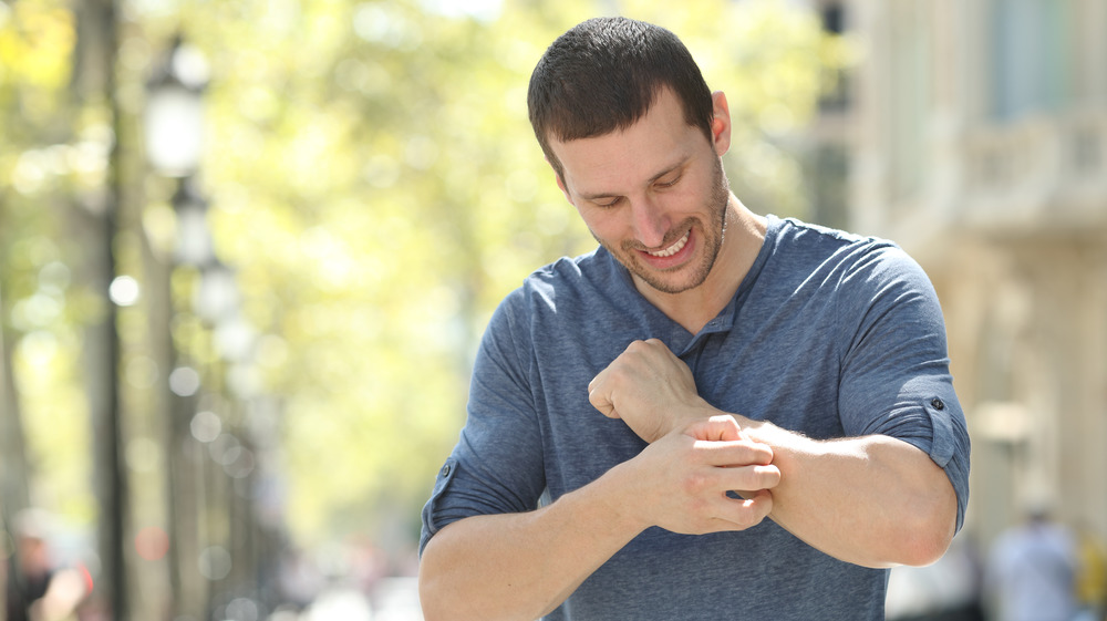 man with eczema