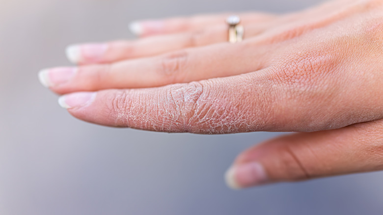 close up of a woman's finger with dry skin 