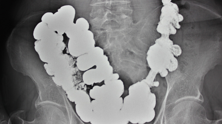 x-ray of person with diverticulosis