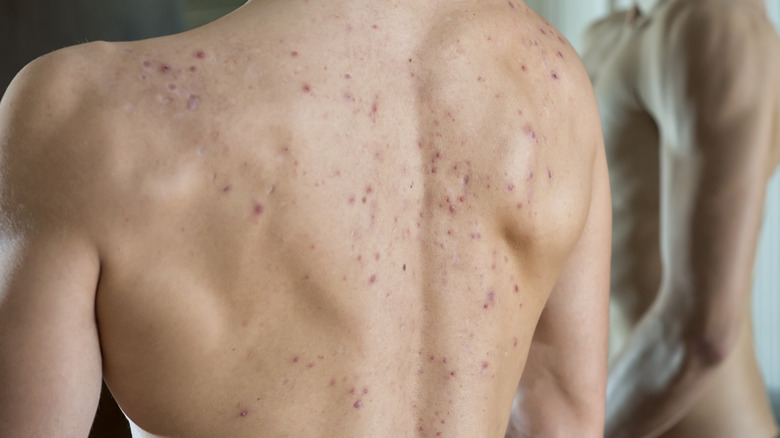 acne and scars on back