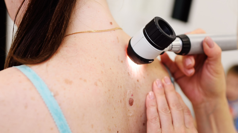 doctor scanning woman's back for skin cancer