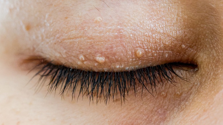 skin tags on eyelid