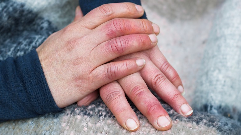 Reddened swollen fingers from poor circulation