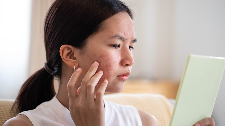 woman looking at acne on her cheek