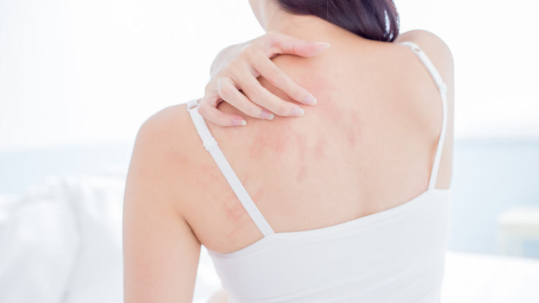 Woman scratching her neck and shoulder with irritated skin