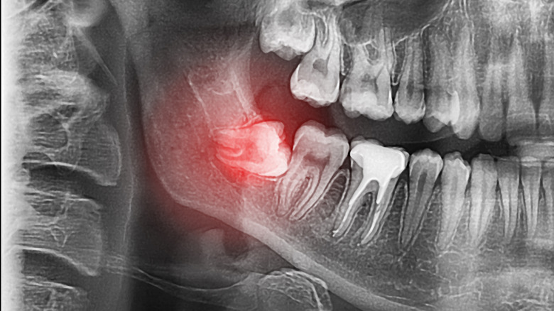 Impacted wisdom tooth X-ray