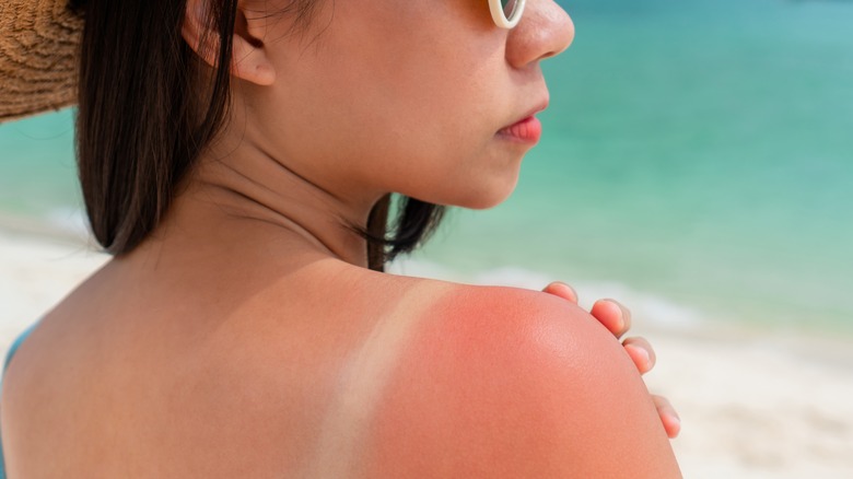 A woman's sunburned shoulder