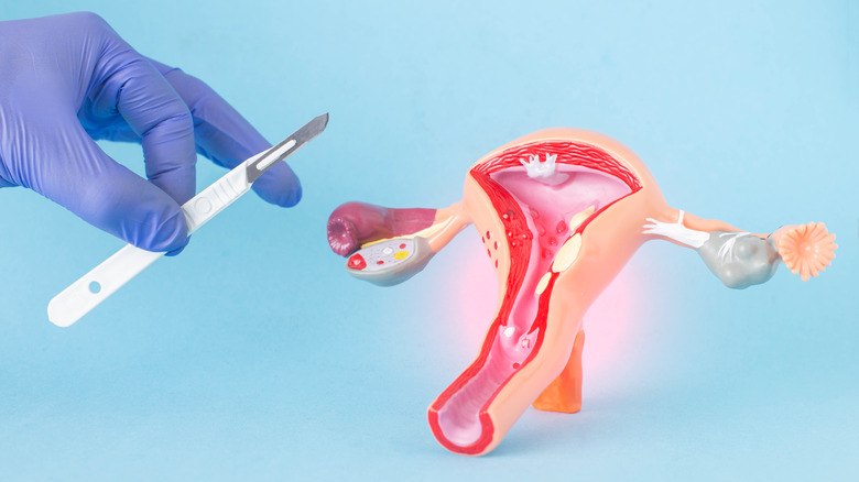 Doctor holds a scalpel over a model of the cross section of a uterus with fibroids