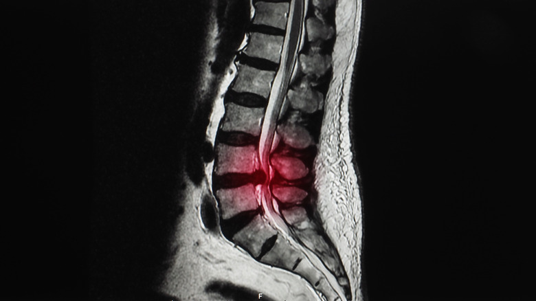 MRI of a herniated disc in the lumbar spine