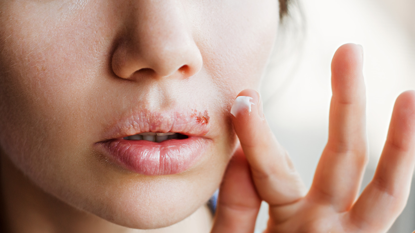 Why You Should Never Pop A Cold Sore