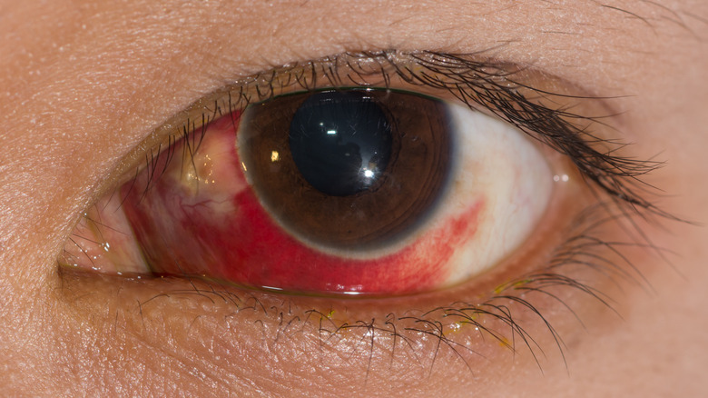 blood pools in eye whites closeup