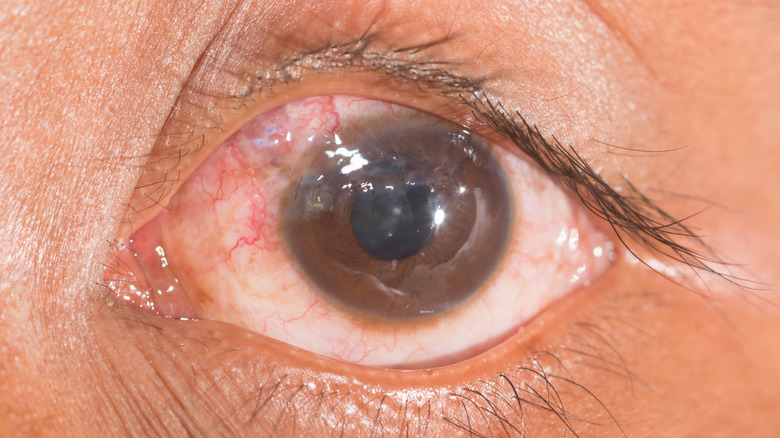 closeup of eye showing trauma