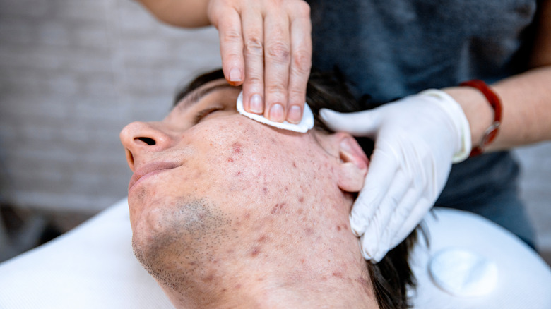 professional treating cystic acne