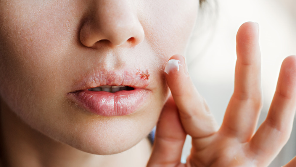 Close up of woman treating cold sore with ointment