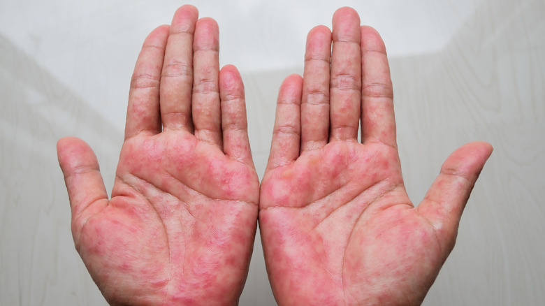 Close up hands with a rash on the palms