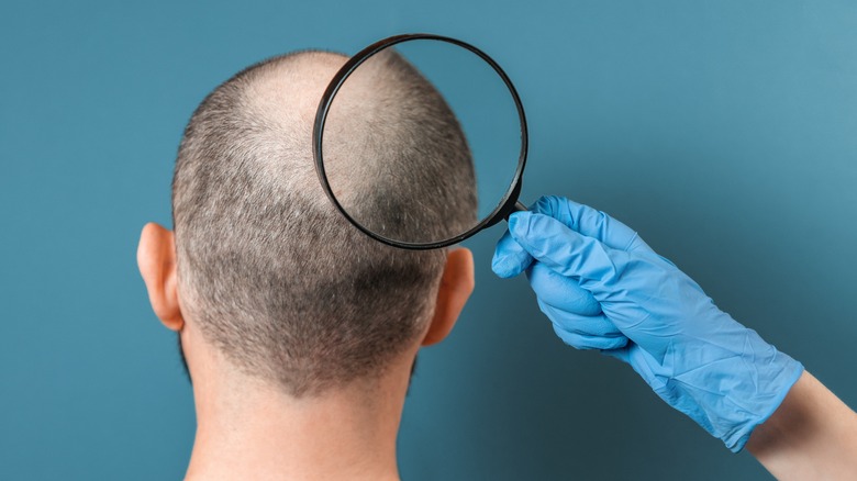 Man with alopecia being examined by doctor