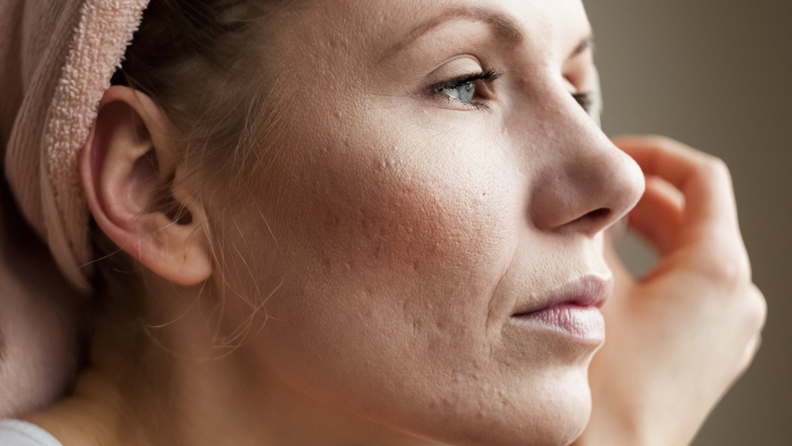 Will Acne Scars Go Away On Their Own 