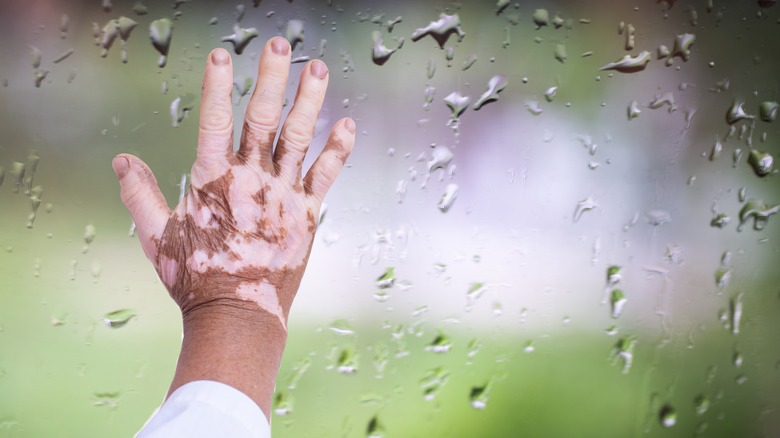 window vitiligo