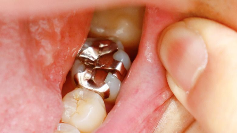 up close of a silver tooth filling