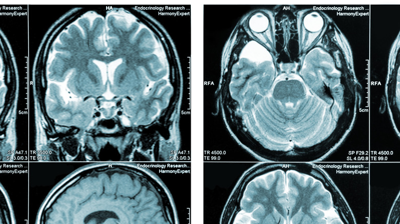 MRI scan of human brain with multiple sclerosis