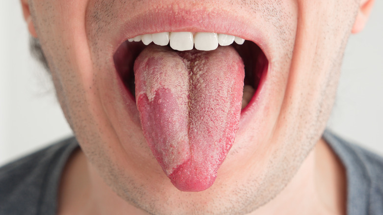 Male with yeast infection in tongue