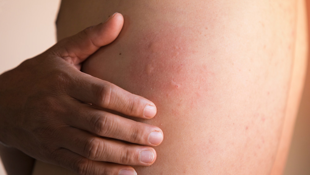 Male torso with hives