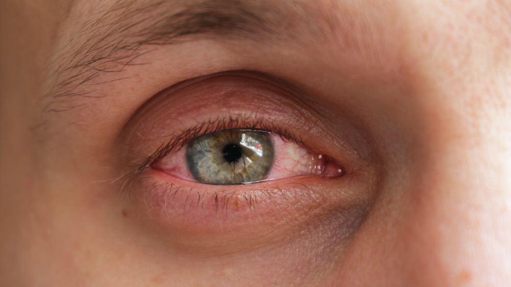 Close up of man's eye with conjunctivitis