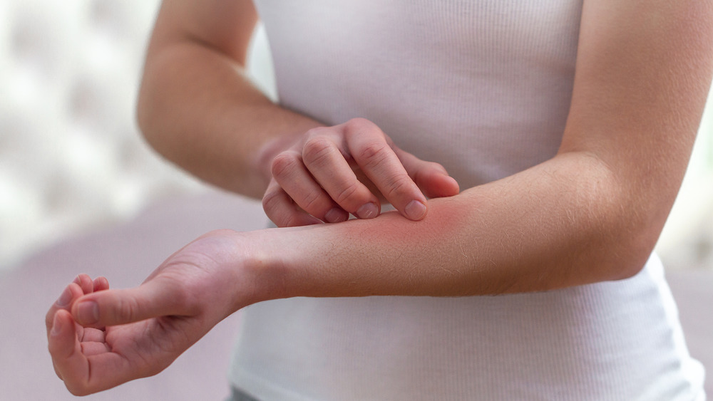 woman scratching rash on arm