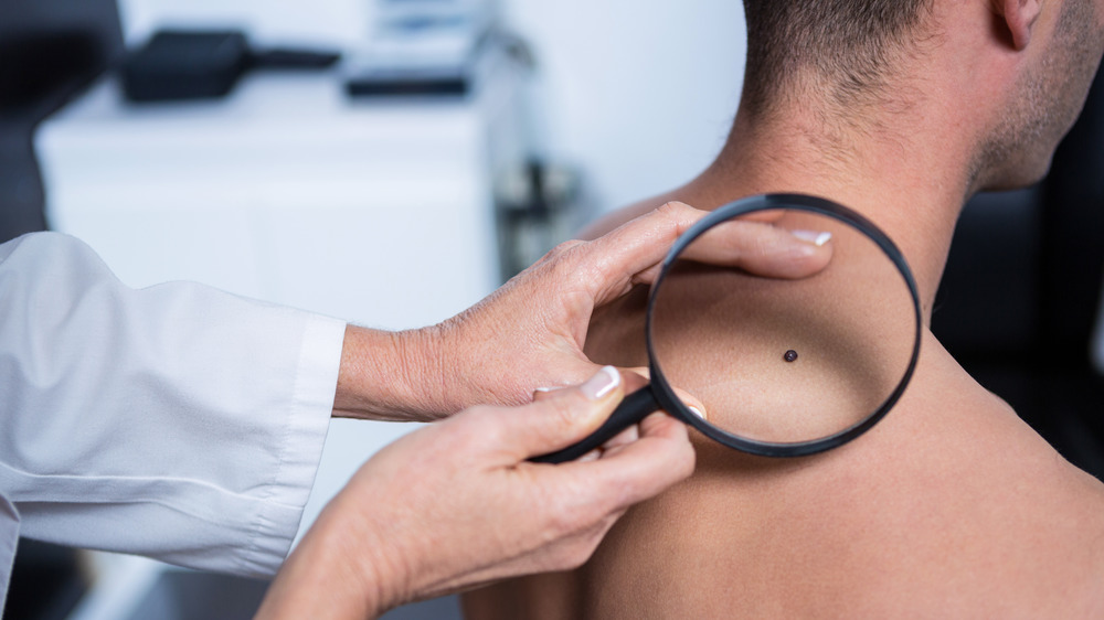 doctor examines mole on man's back