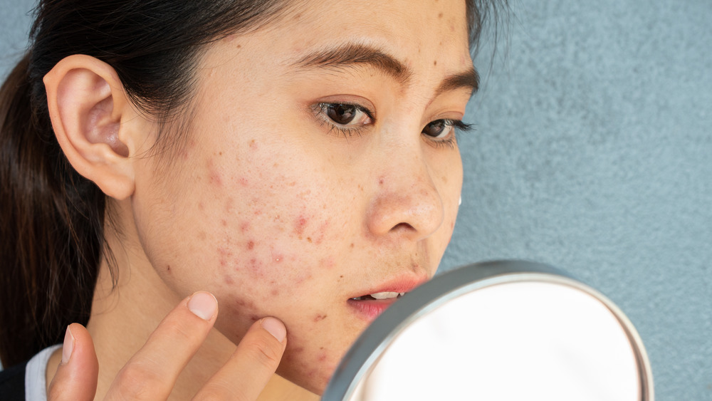 woman with acne looking in mirror