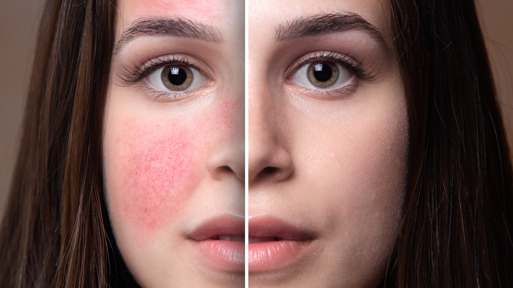 rosacea before and after treatment