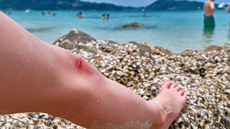 open leg wound on beach