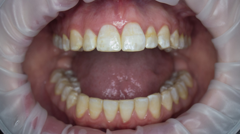 A close up inside a mouth showing teeth and tongue 