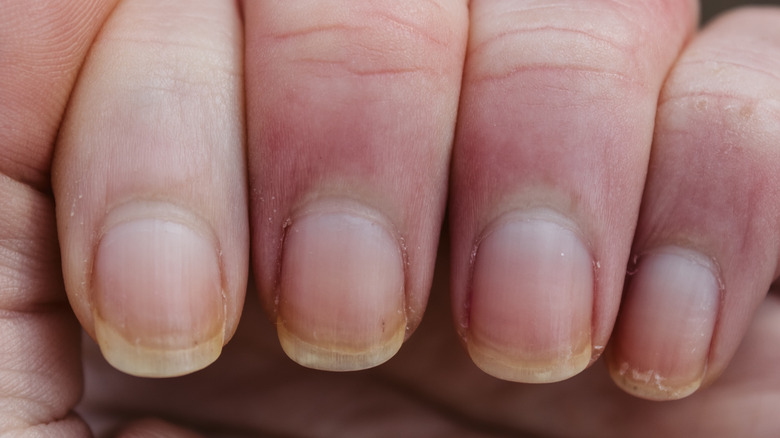 close-up of brittle nails